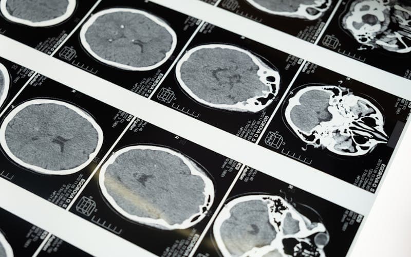 Traumatic Brain Injuries